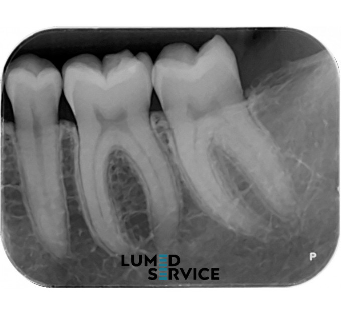 Візіограф Woodpecker i-Sensor H1 USB стоматологічний цифровий рентген сенсор